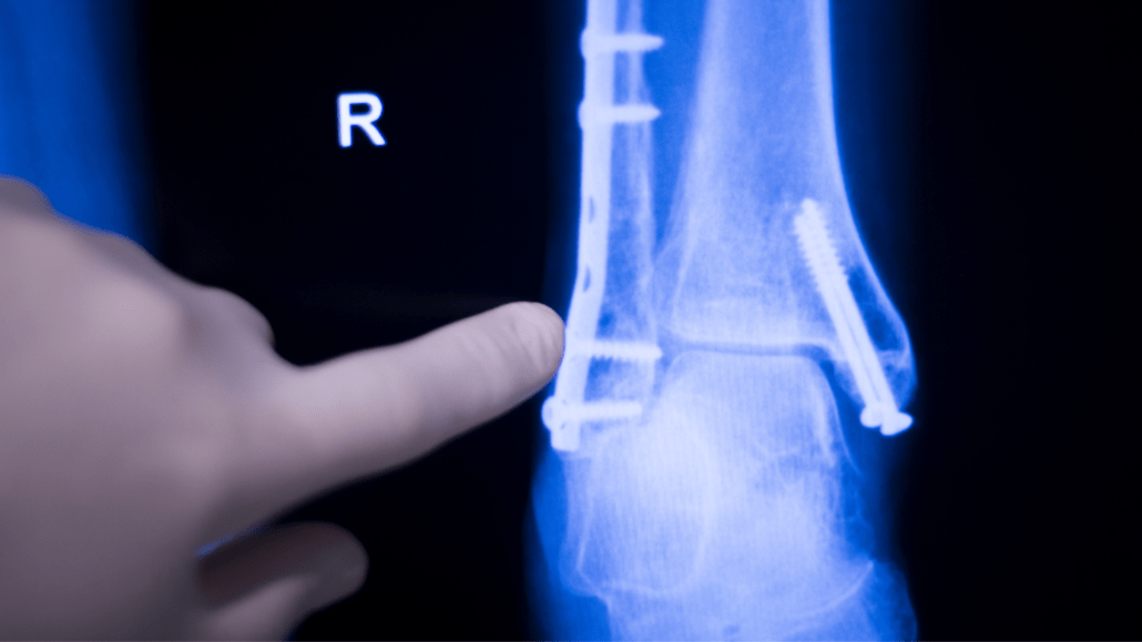 Minimally Invasive Knee Replacement Surgery In Hyderabad TS minimally-invasive-knee-replacement-surgery-in-hyderabad-ts